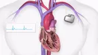 A small battery-operated device can save heart patients thumbnail