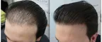 Why hair replacement is getting popular among people? thumbnail