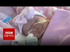 A surgery needed to be done to save a baby whose heart was beating outside her chest thumbnail