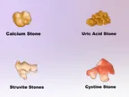 How does Kidney Stone form? thumbnail