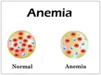 What is Anemia? thumbnail