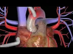 Many things to know about “Heart Bypass Surgery” thumbnail