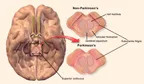 What is Parkinson’s disease? thumbnail