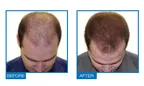 Is there any medicine for hair regrowth? thumbnail