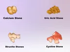 Insufficient water in your body can increase the risk of Kidney Stones thumbnail