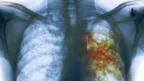 114 countries decide to work together to eliminate Tuberculosis by 2030 thumbnail